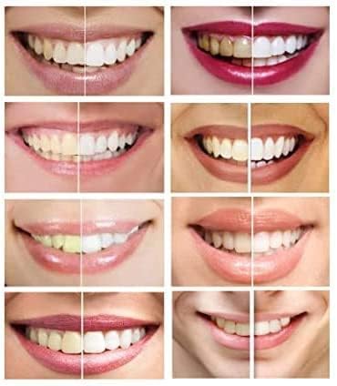 White Teeth Global 10 špricevi Novi najjači Gel za izbjeljivanje zuba sa 44% karbamid peroksidom